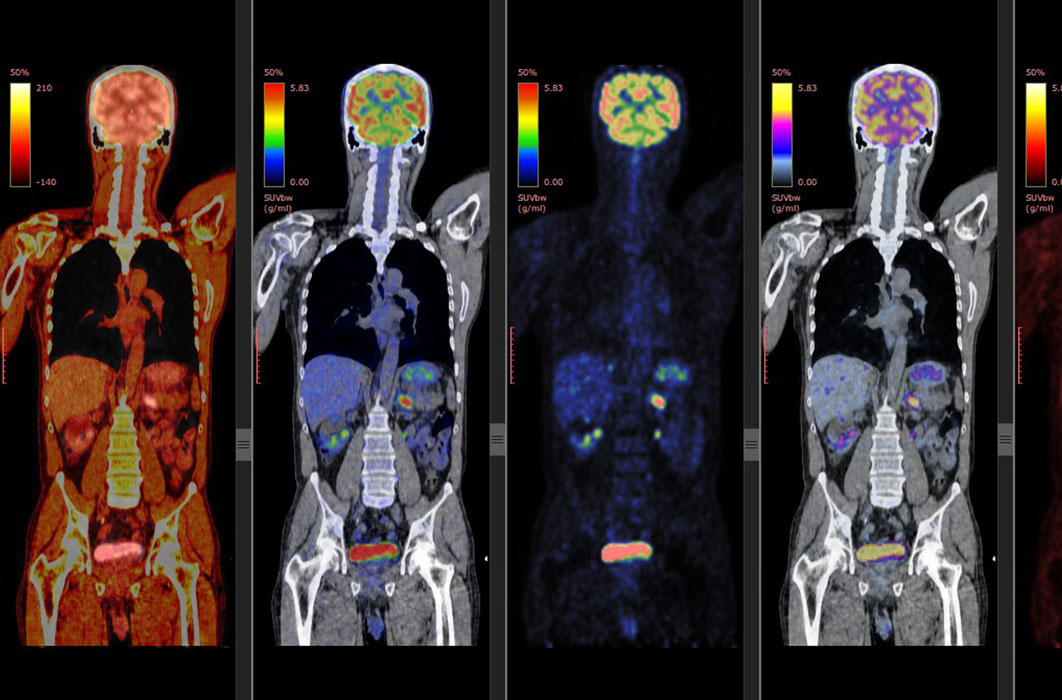 pet scan chandigarh
